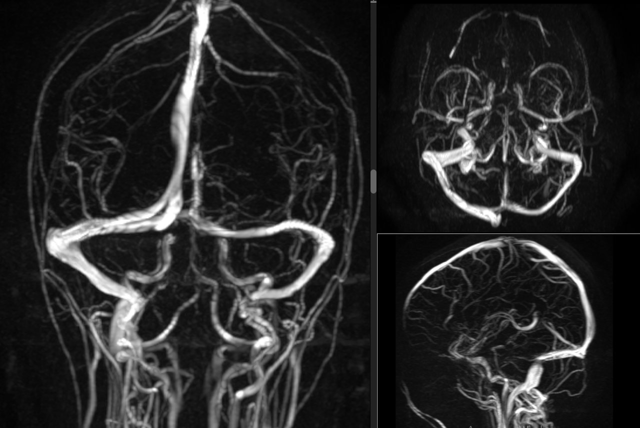 МРТ головного мозга с ангиопрограммой